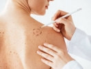 Câncer de pele: no Brasil são registrados 185 mil novos casos a cada ano